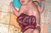 Gastroschisis