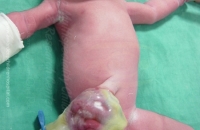 Omphalocele / Exomphalos