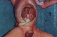 Omphalocele / Exomphalos