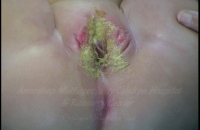 Recto Vaginal Fistula (stools coming from vagina)