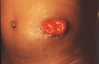 Sigmoid colostomy in a child