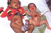 Two babies with transverse colostomy
