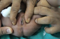 Child with anorectal malformation (before surgery)