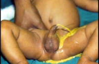 stool coming from the penis in a child with anorectal malformation