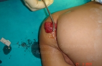 Rectal polyp