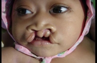 Bilateral cleft lip