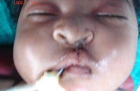 Immediately after cleft lip repair