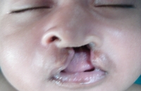 Unilateral cleft lip