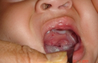 After Cleft Palate repair