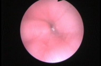 Gastroscopy (G.E. Junction)