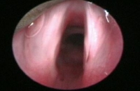 Epiglottis seen at bronchoscopy