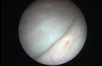 Cystoscopy (ureteric opening seen)