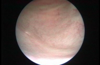 Cystoscopy (ureteric opening seen)