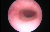 Gastroscopy - Oesophagus