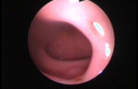 Gastsoscopy - Duodenum