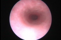 Cystoscopy - Urethra