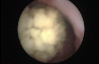 Stone in the ureter on cystoscopy