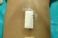 Eraser removed from the stomach
