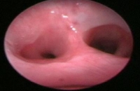 Bronchoscopy - Tracheal bifurcation