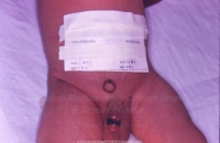 Complication of circumcision by quacks
