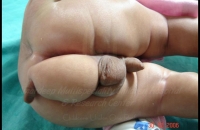 Child with Double Penis