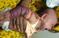 Extensive hemangioma over arm