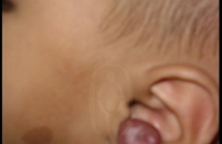 Hemangioma over the pinna (ear lobe)