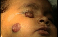 Hemangiomas over the cheek and eye