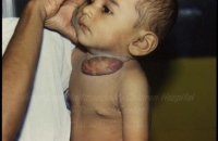 Hemangioma over the neck