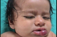 Healed hemangioma over the lip before sclerotherapy (injection treatment)