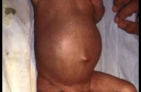 Obstructed Inguinal hernia (Boy)
