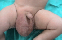 Large right inguinal hernia