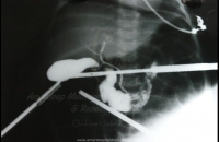 Laparoscopic Cholangiography