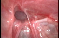 Right Inguinal hernia seen at laparoscopy