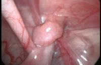 Obstructed inguinal hernia seen at laparoscopy