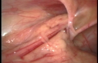 Left inguinal hernia seen at laparoscopy
