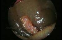 Neonatal Hepatitis with normal gall bladder