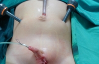 Laparoscopy for intra abdominal testis