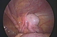 Low intra abdominal testis