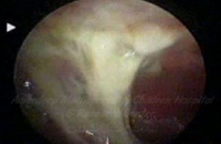 Empyema stage 1 (pus in chest)