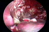 Empyema stage 2 (pus in chest)