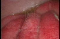 Typhoid perforation