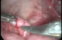 Colonic biopsy for Hirschsprung's disease