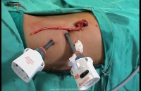 Laparoscopic Nephrectomy