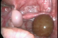 Torted right ovarian cyst