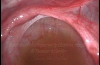 Purulent peritonitis (pus in abdomen)