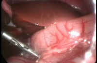 Pyloric Stenosis