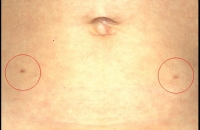 scars after laparoscopy
