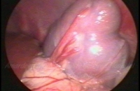 Spleenic abscess