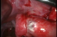 Perforated appendicitis